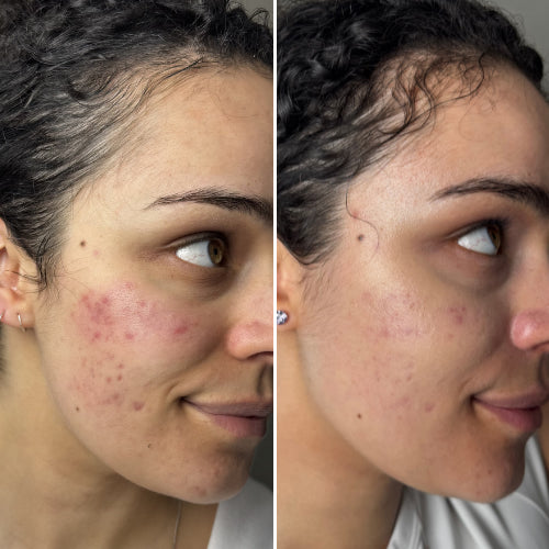 Ledoré AuraMask – LED Multi Light Therapy Mask + FREE GIFT